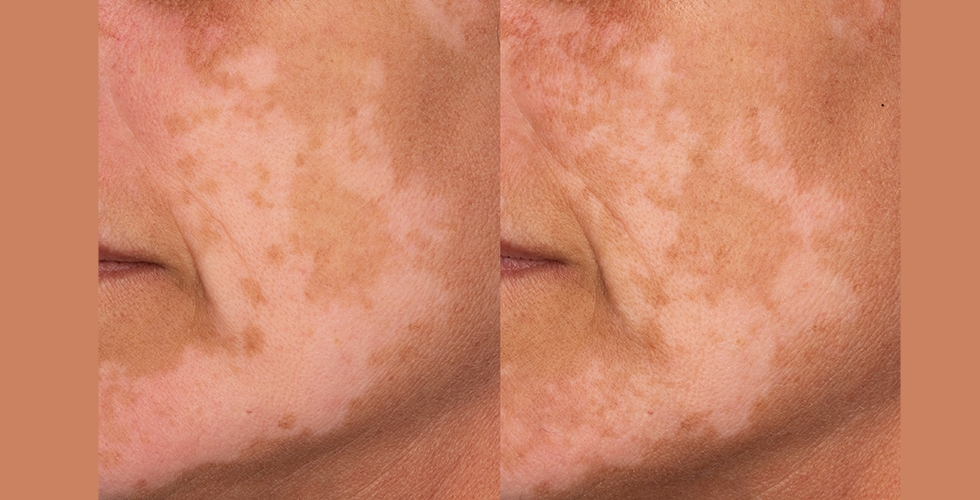Clinical Study- Evaluating the Whitening Effect of Mineral Sunscreens in Multi-Cultural Skin Tones - Validated Claim Support