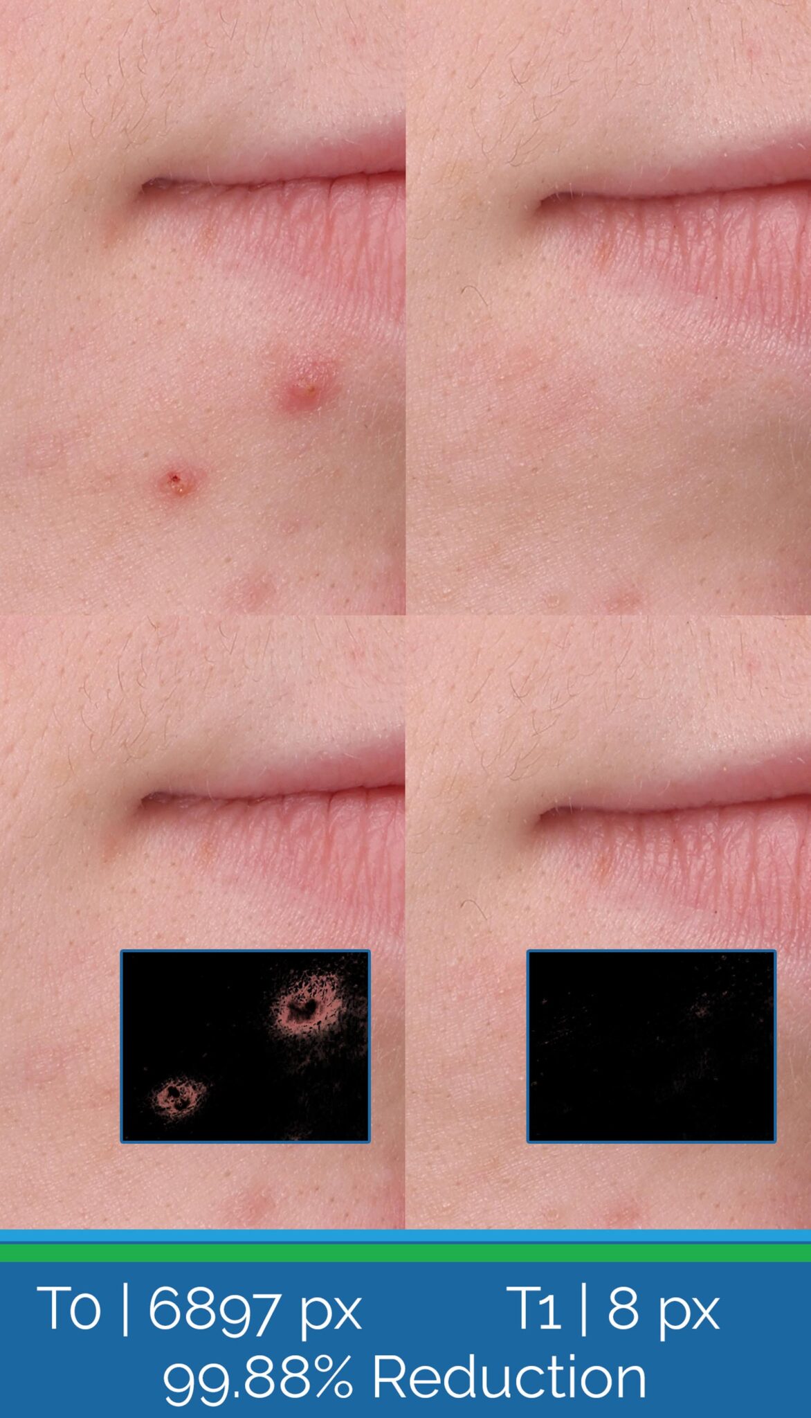 Closeup Acne and Redness Reduction Clinical Before and After