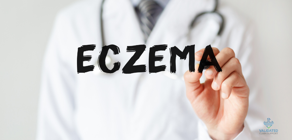 Eczema - pic 6 944 x 453 px