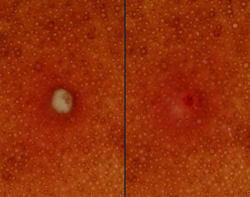 Acne lesion, baseline compared with result