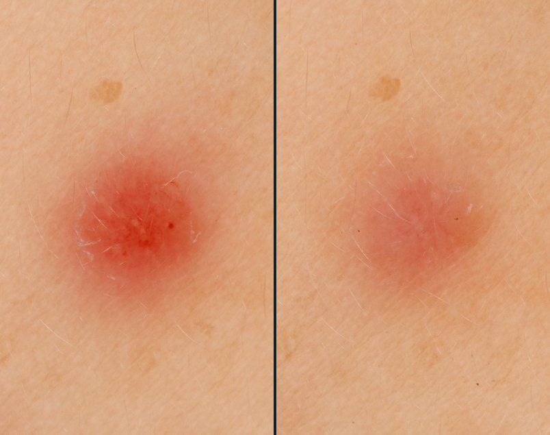 Blemish redness, baseline compared with day 3