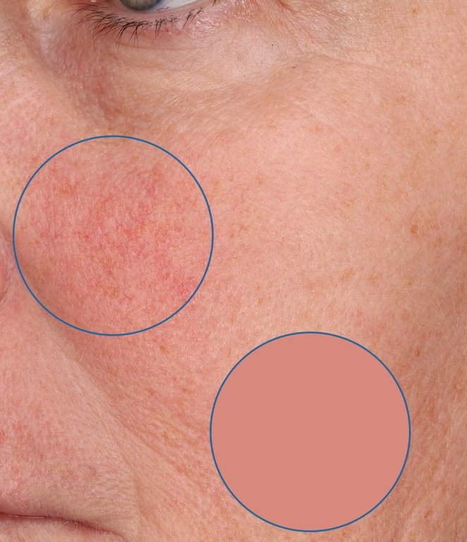 Redness reduction at baseline