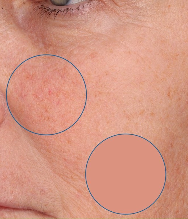 Redness reduction at week 2