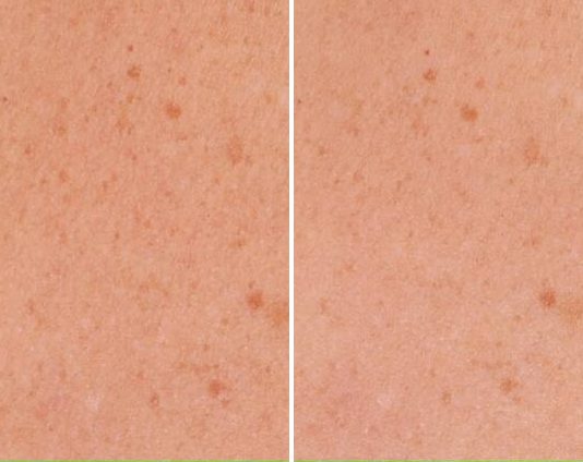 Age Spots & Hyperpigmentation case study, baseline compared with result