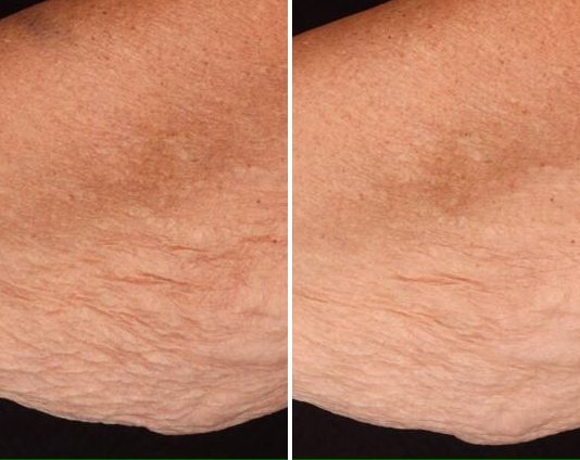 Anti-Aging Claims case study, baseline compared with result
