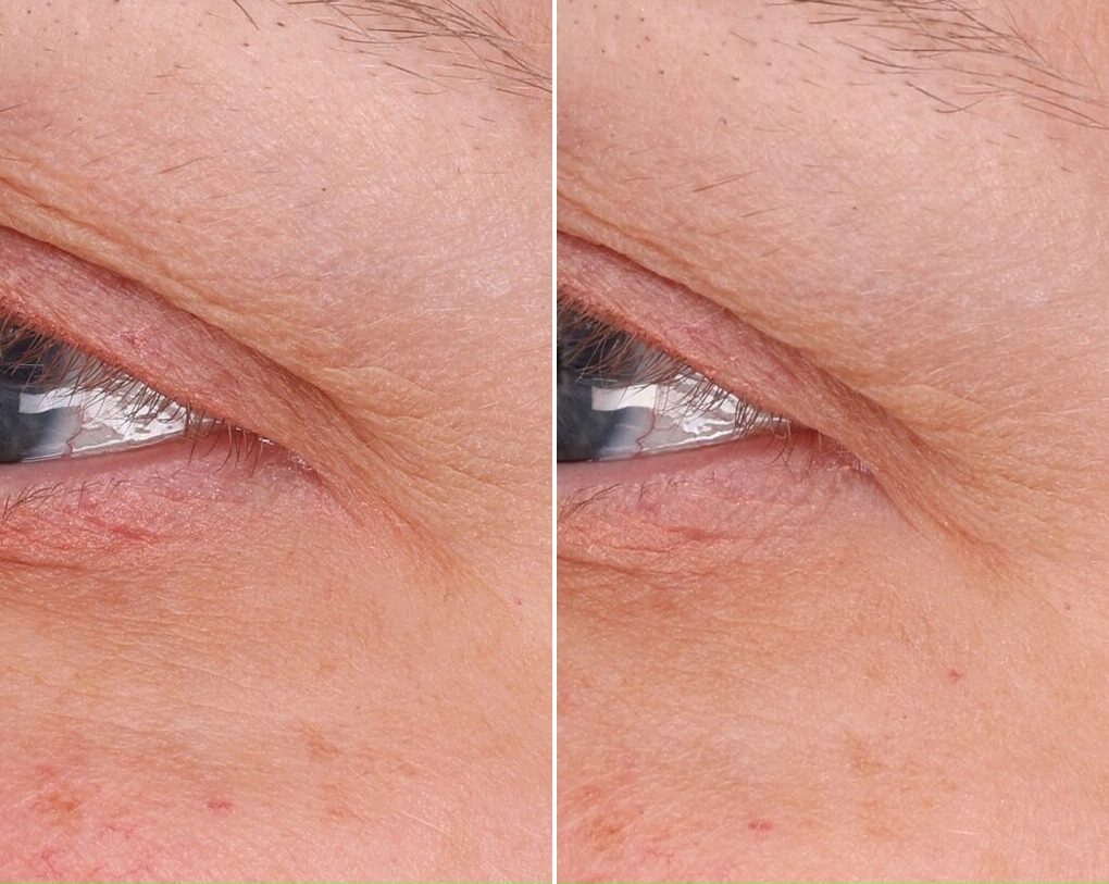 Fine Lines Wrinkles case study, baseline compared with result