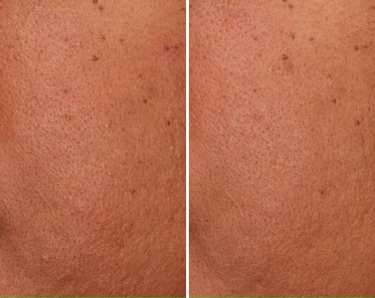 Acne & Pore Reduction case study, baseline compared with result