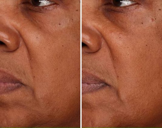 Visual Skin Changes case study, baseline compared with result