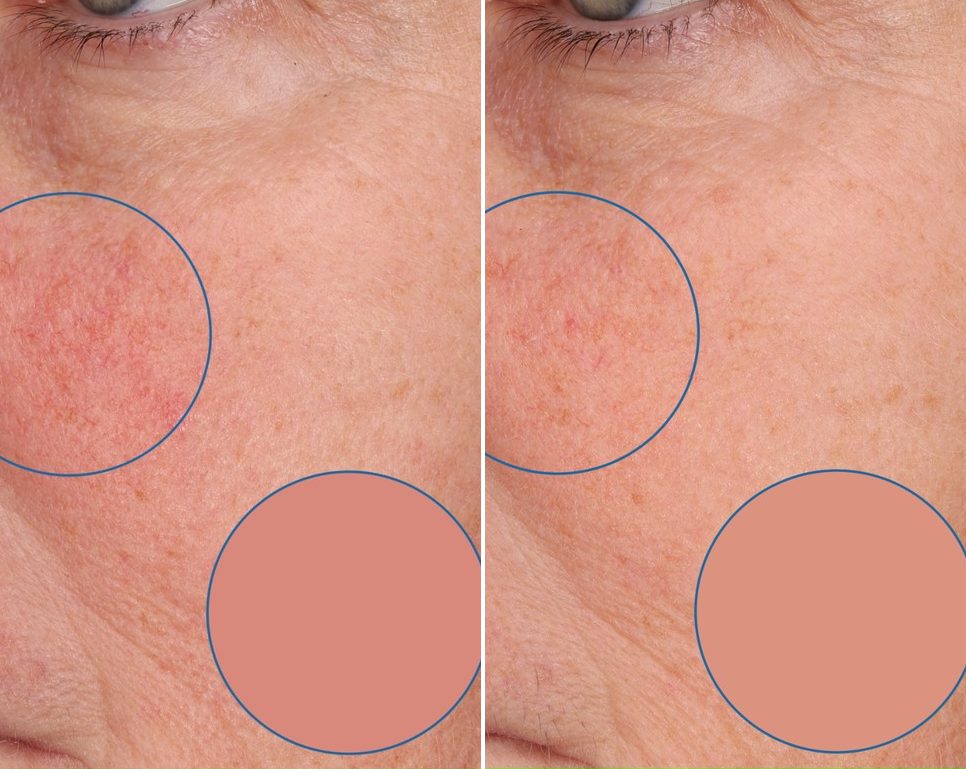 Redness Reduction & Safety case study, baseline compared with result