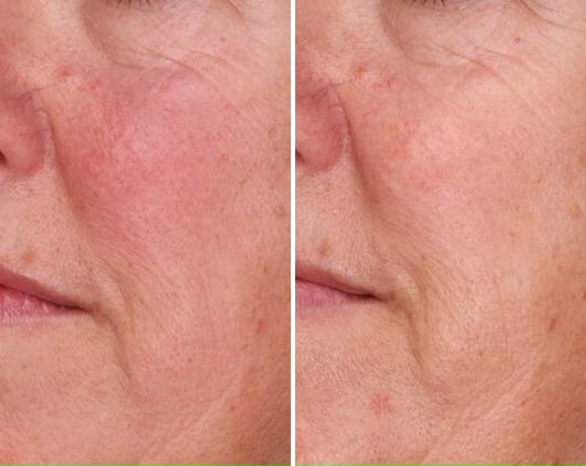 Skin Tone & Complexion case study, baseline compared with result