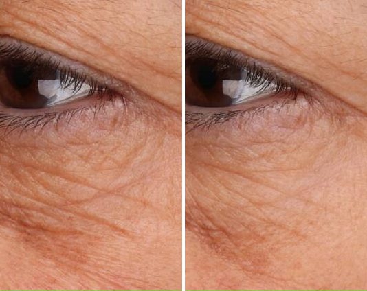 Undereye Products case study, baseline compared with result