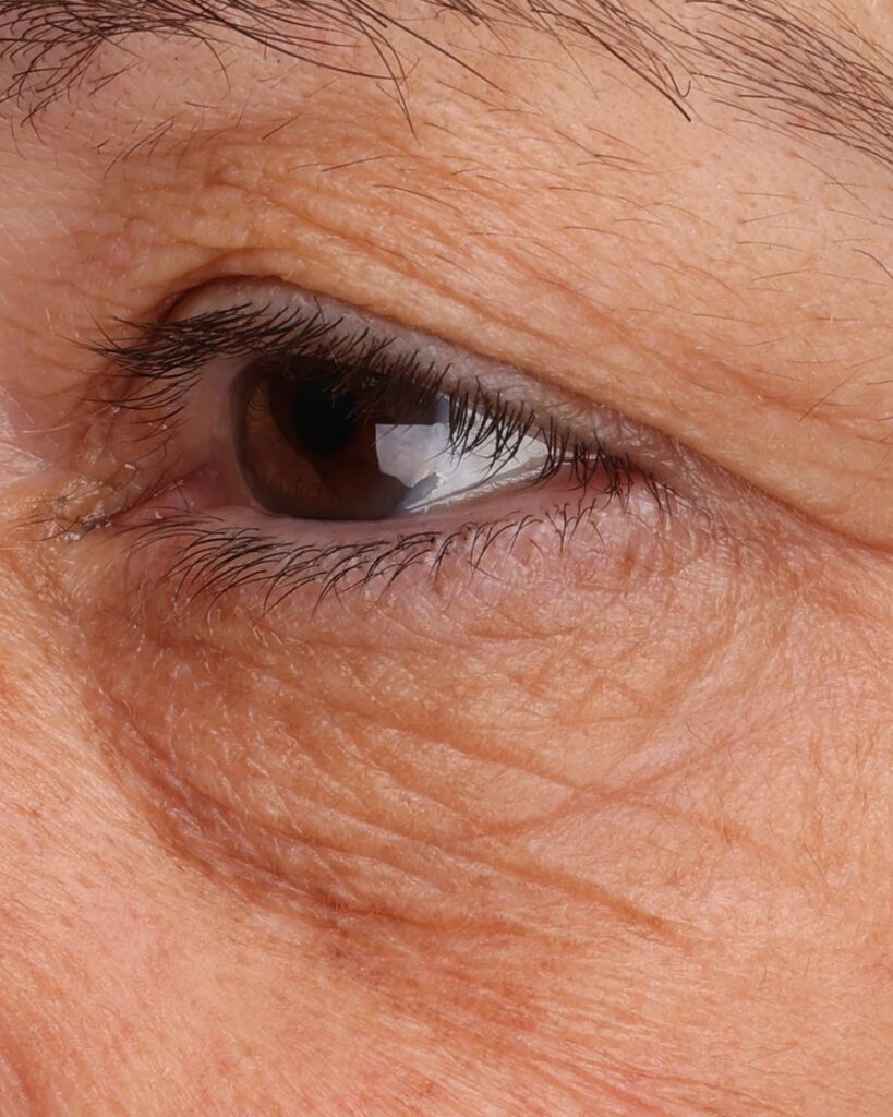Baseline clinical photograph of the under-eye area