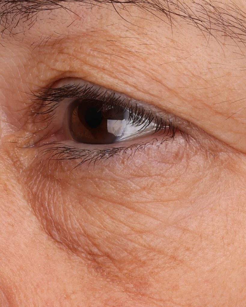 Week 6 clinical photograph of the under-eye area