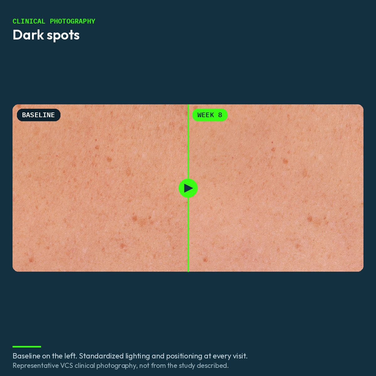 Representative VCS clinical photograph of dark spots, baseline and week 8
