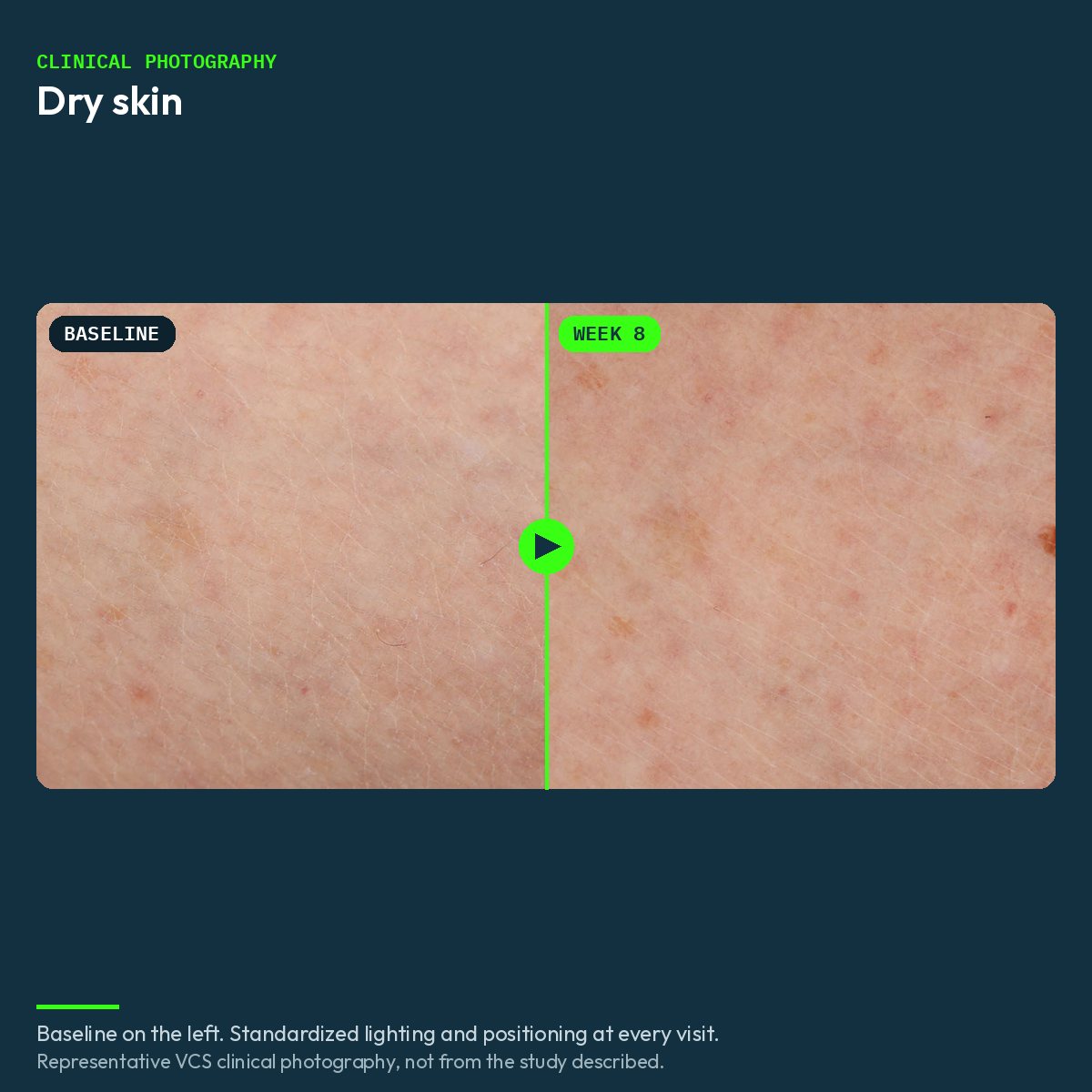Representative VCS clinical photograph of dry skin, baseline and week 8