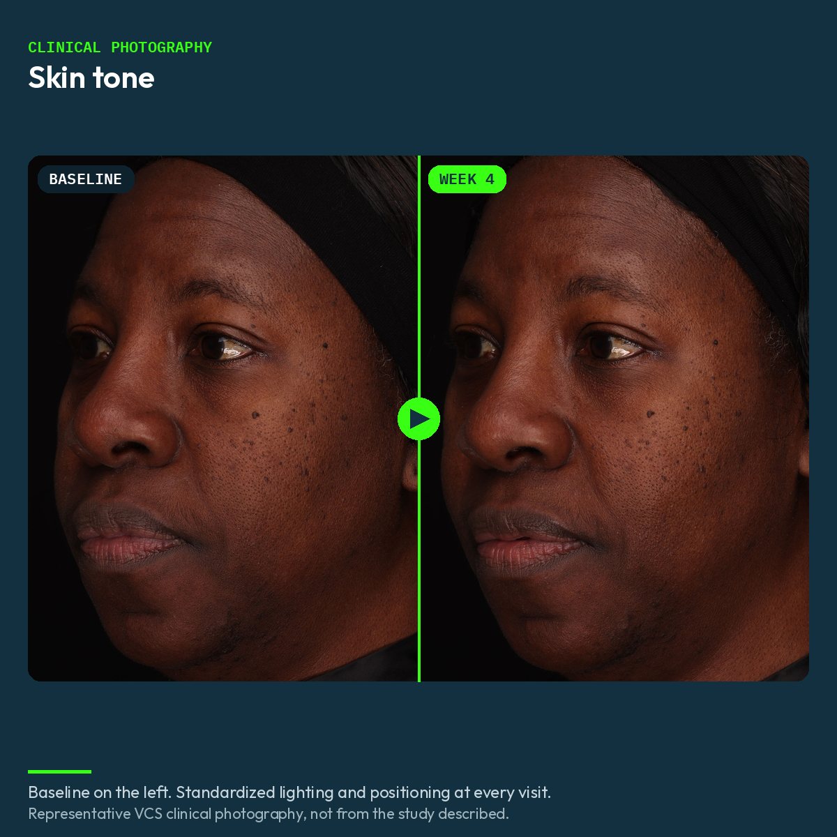 Representative VCS clinical photograph of skin tone, baseline and week 4