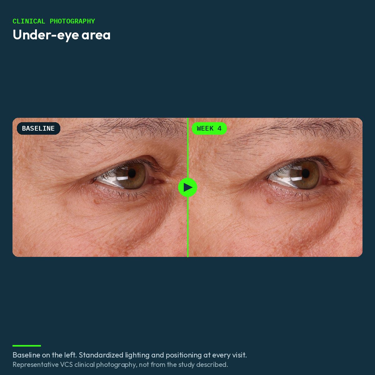 Representative VCS clinical photograph of the under-eye area, baseline and week 4