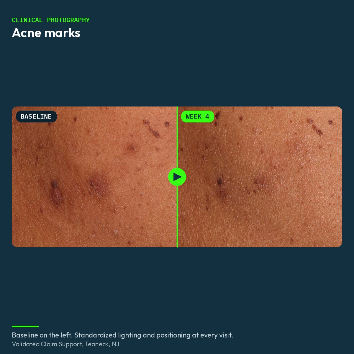 Clinical before and after close-up of acne marks, baseline and week 4