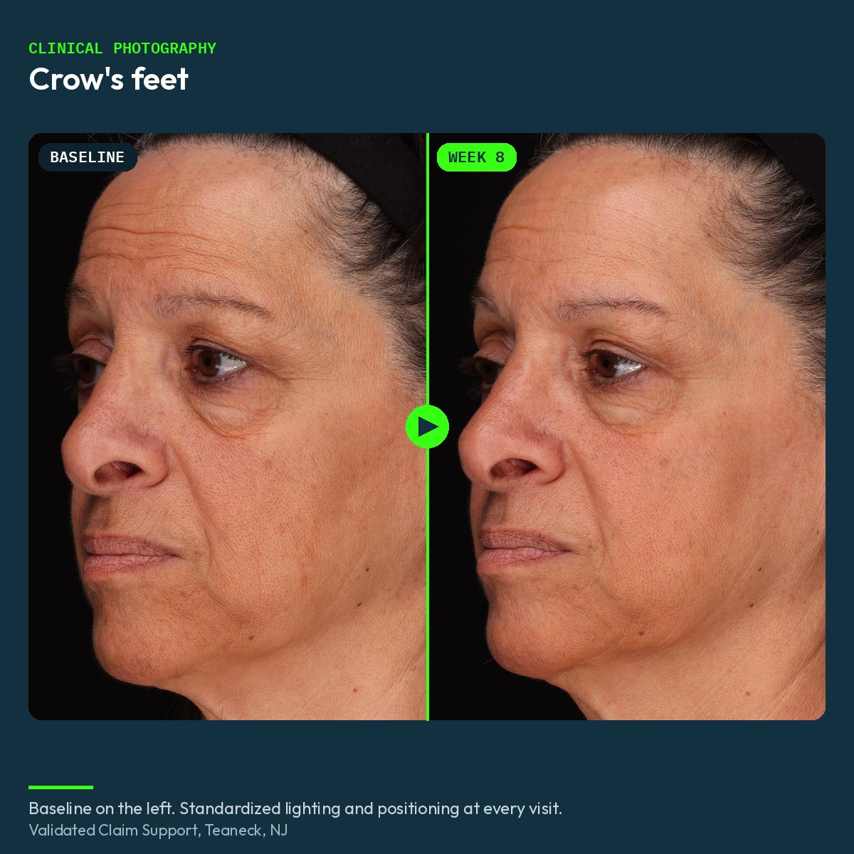 Clinical before and after photograph of crow's feet, baseline and week 8