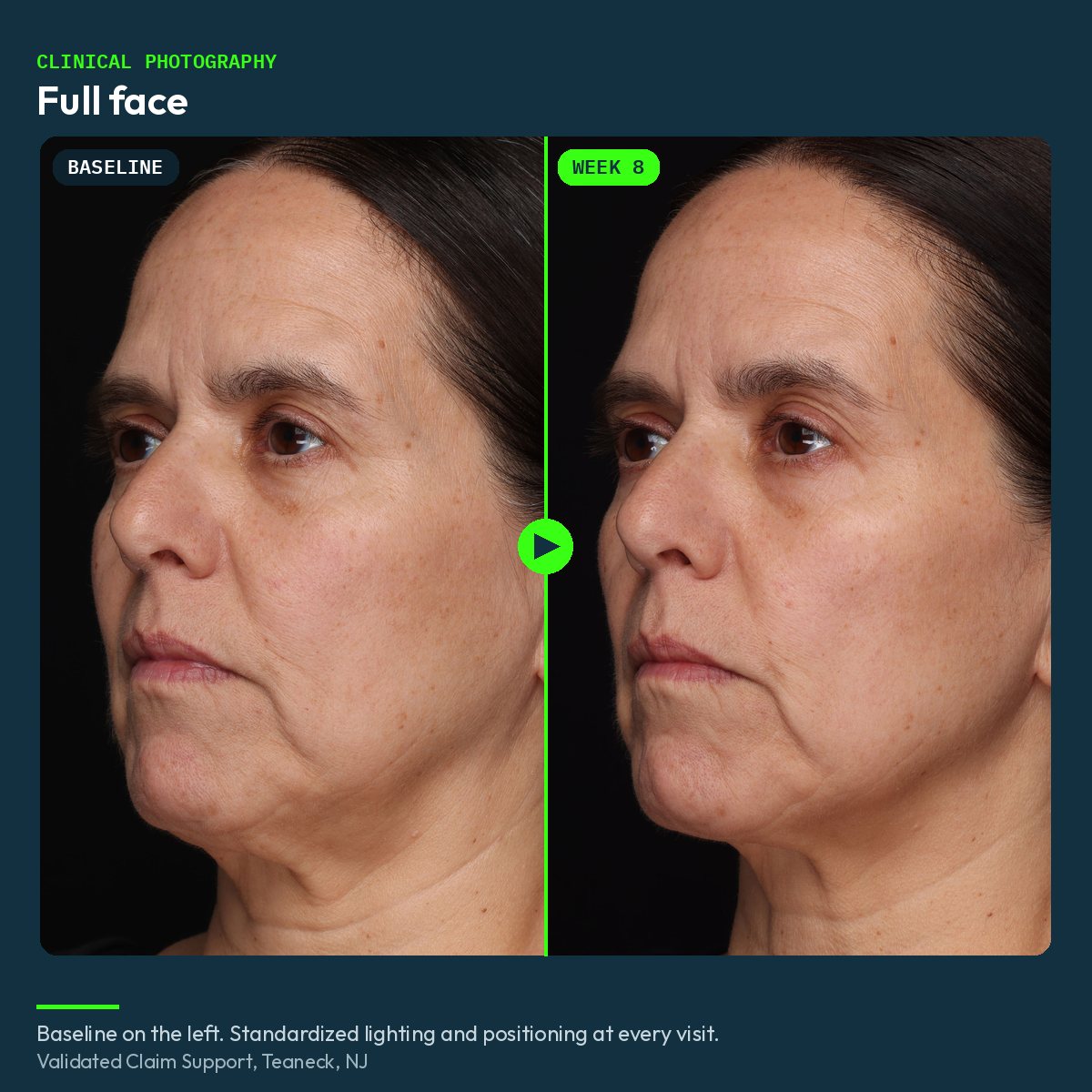 Clinical before and after photograph of the full face, baseline and week 8