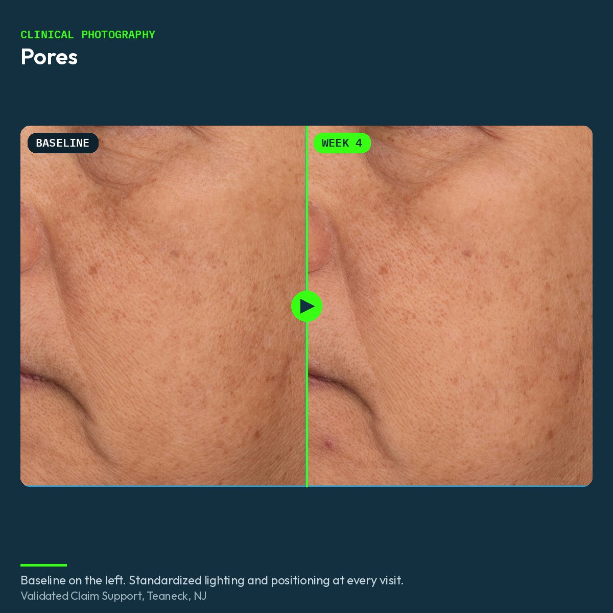 Clinical before and after close-up of pores, baseline and week 4