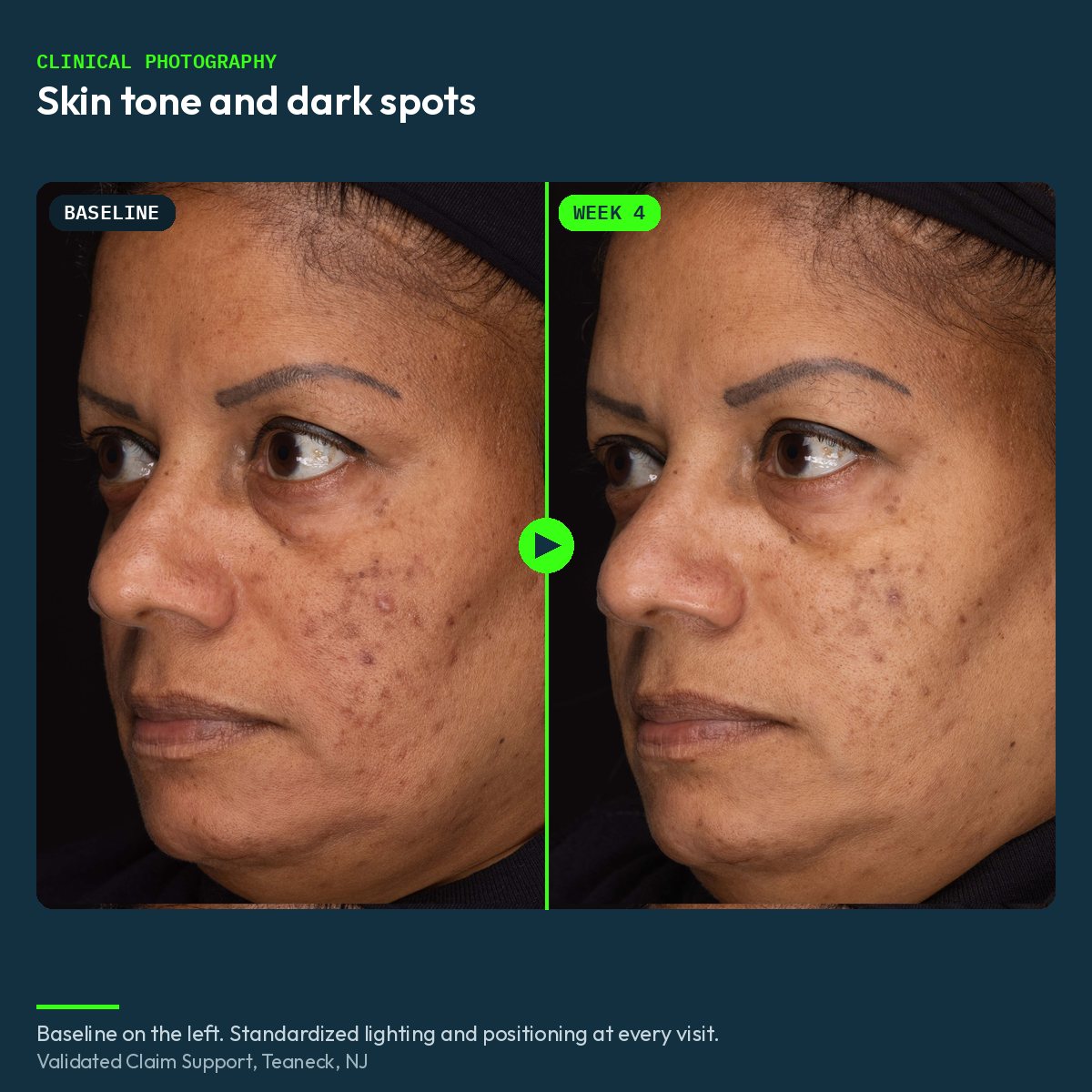 Clinical before and after photograph of skin tone and dark spots, baseline and week 4