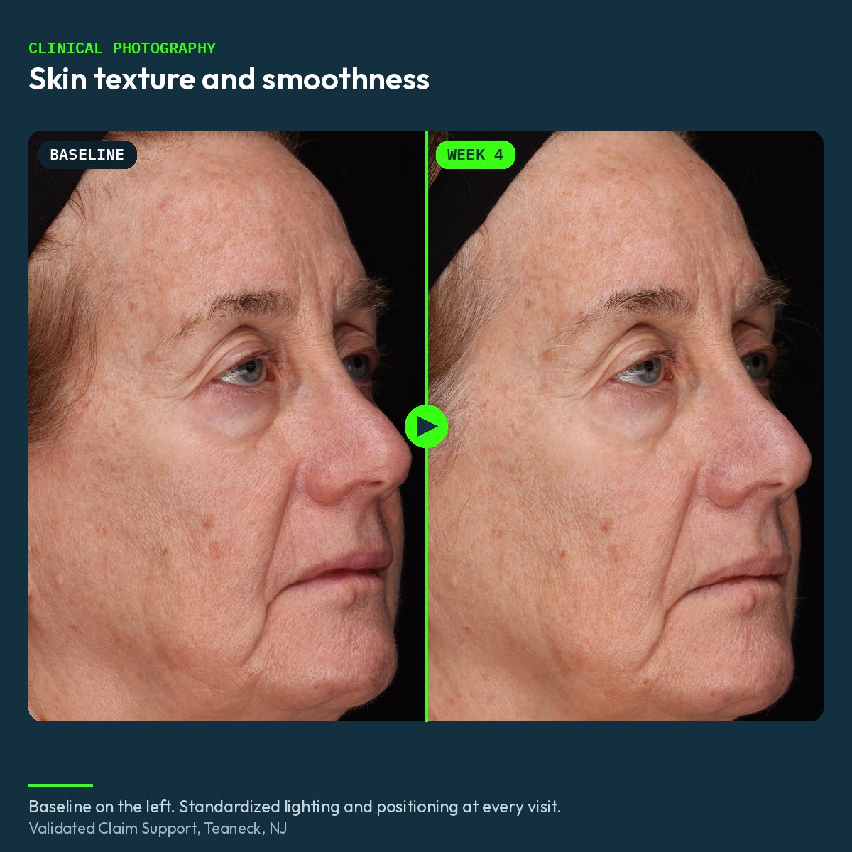 Clinical before and after photograph of skin texture, baseline and week 4