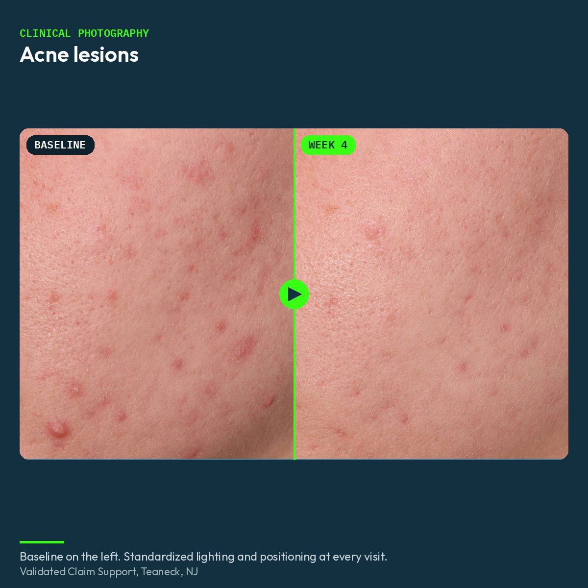 Clinical before and after close-up of acne lesions, baseline and week 4