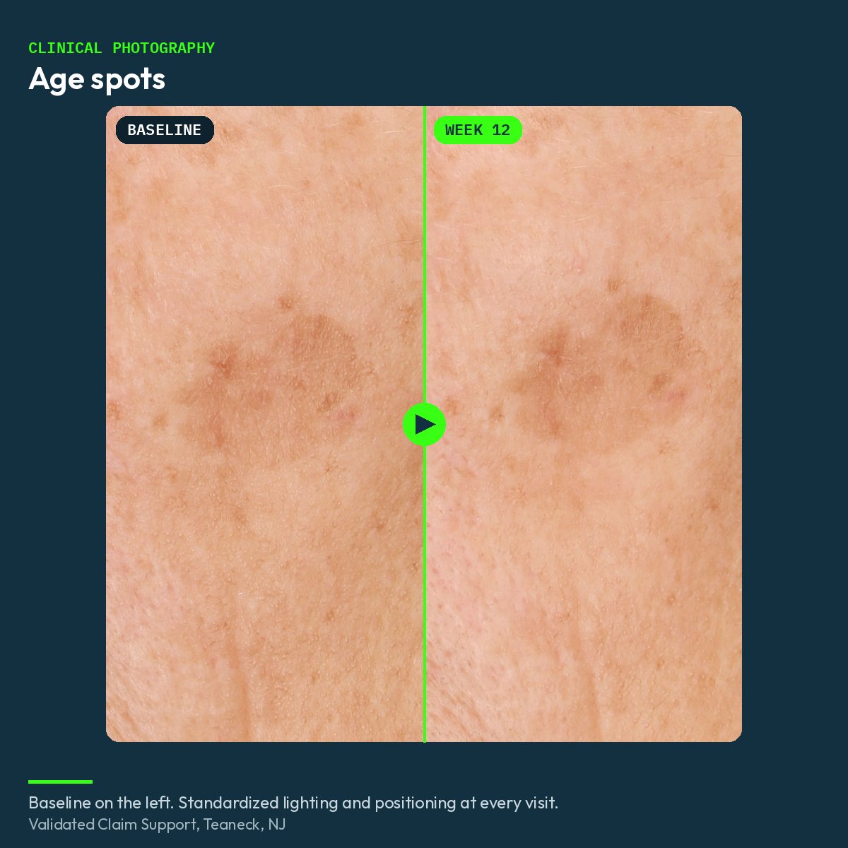 Clinical before and after close-up of age spots, baseline and week 12