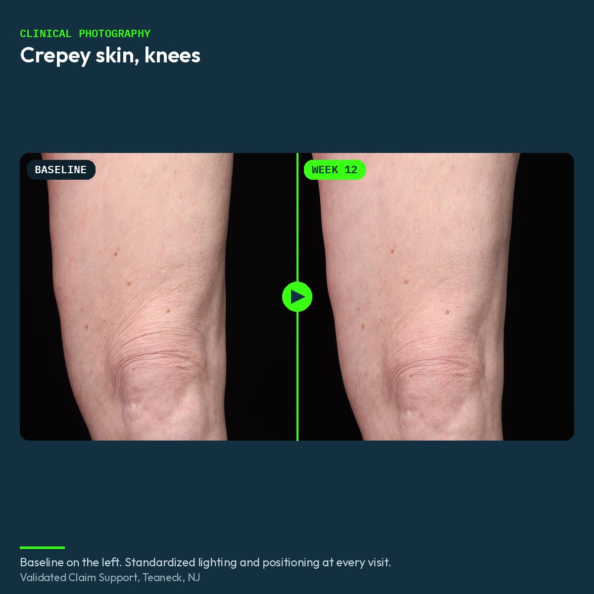 Clinical before and after photograph of crepey skin on the knees, baseline and week 12