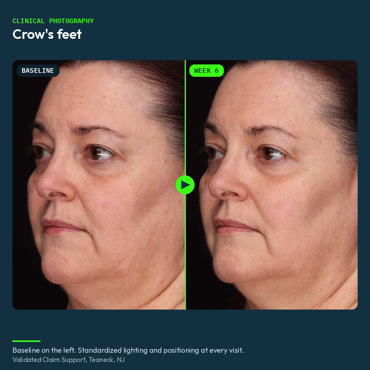 Clinical before and after photograph of crow's feet, baseline and week 6