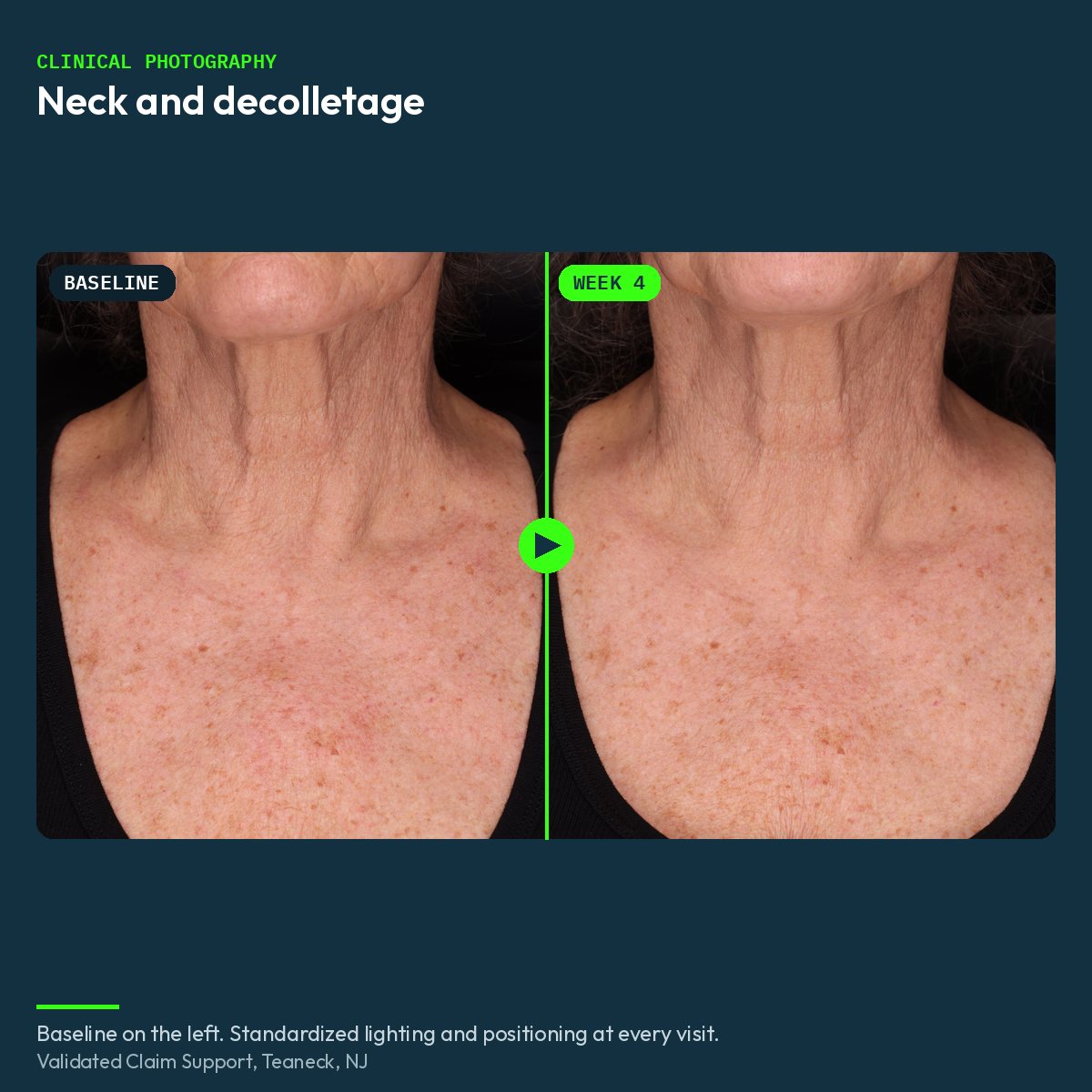 Clinical before and after photograph of the neck and decolletage, baseline and week 4