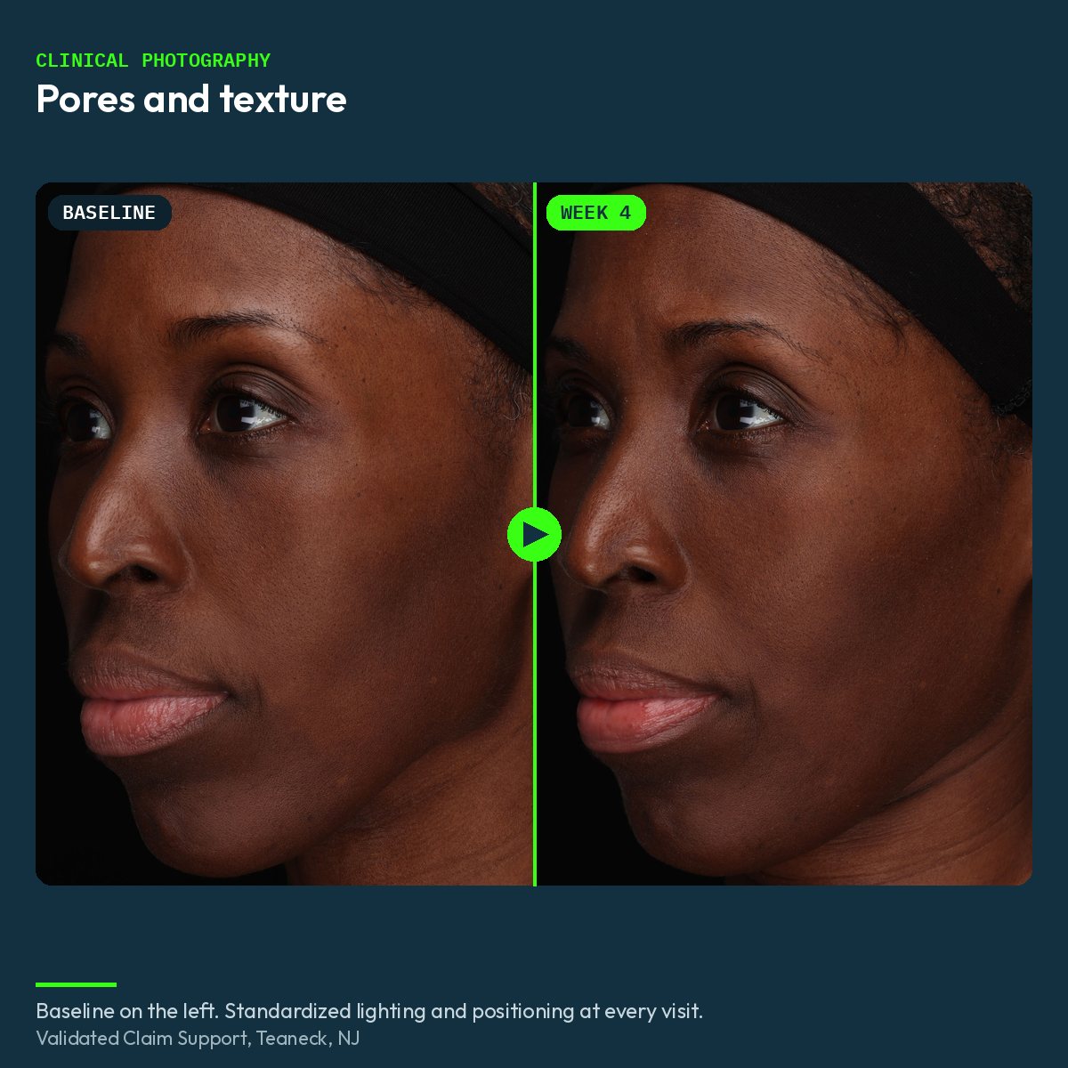 Clinical before and after photograph of pores and texture, baseline and week 4