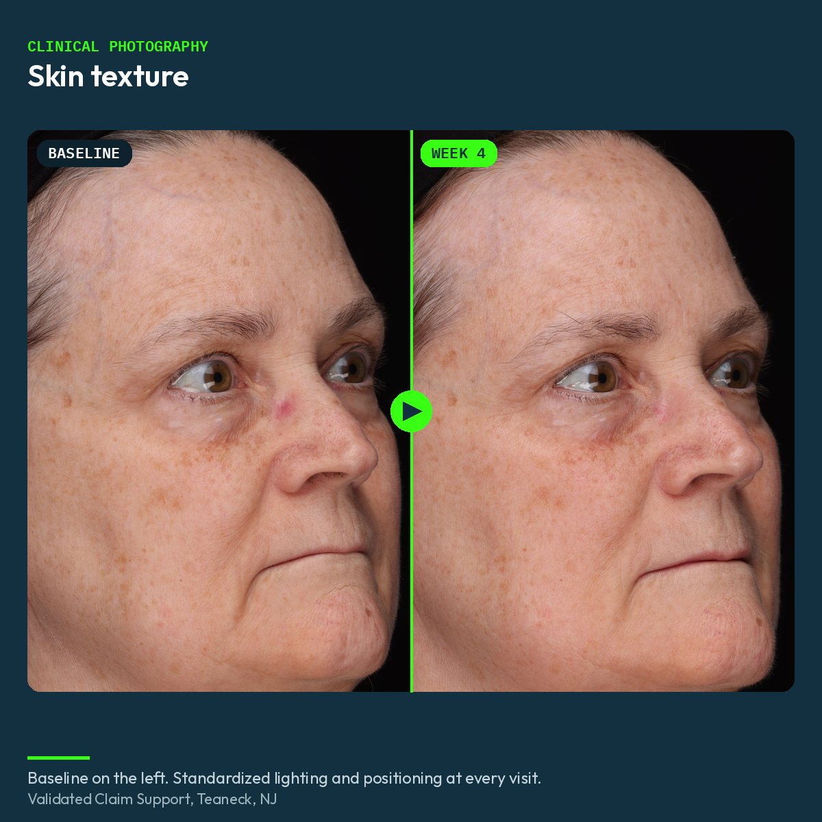 Clinical before and after photograph of skin texture, baseline and week 4