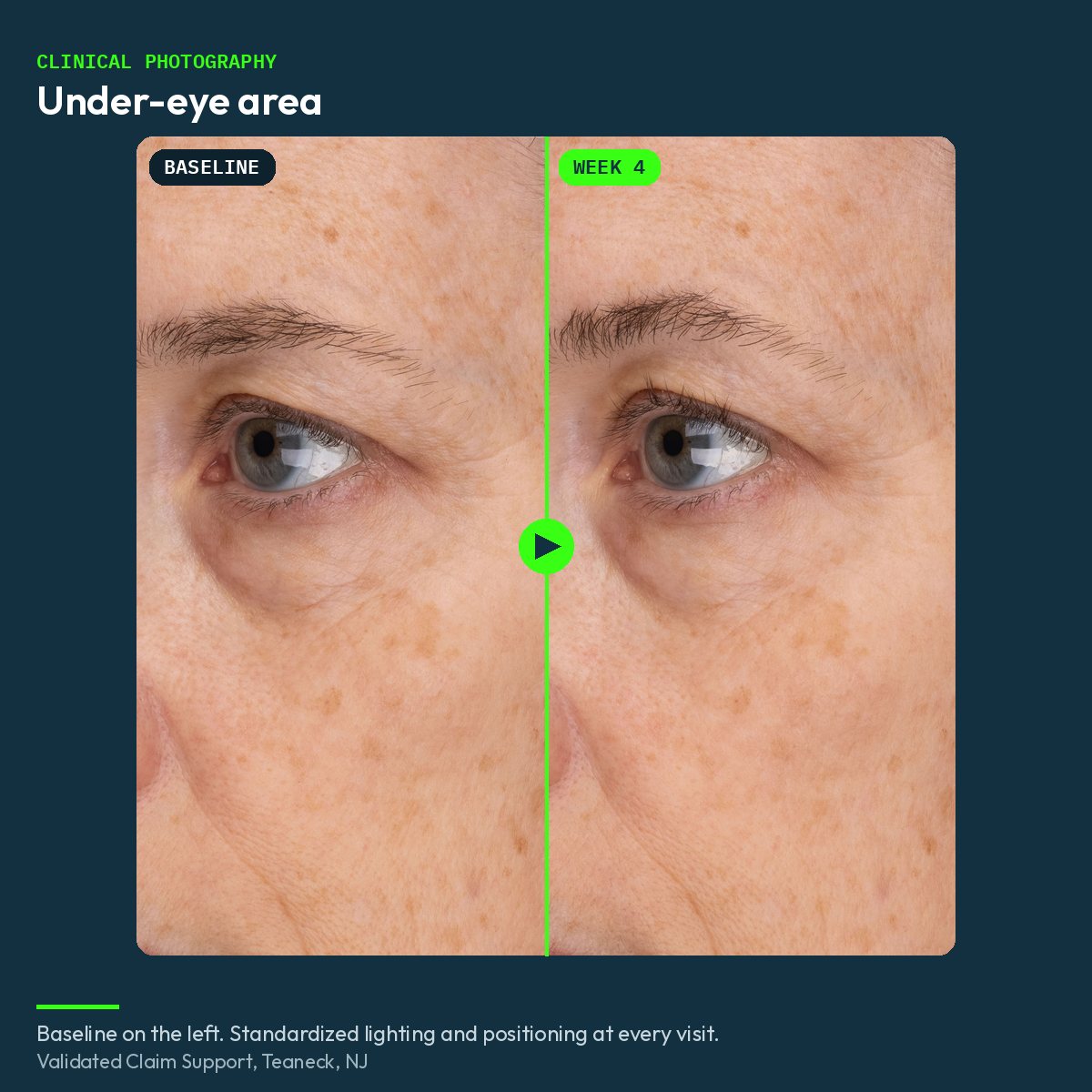 Clinical before and after close-up of the under-eye area, baseline and week 4