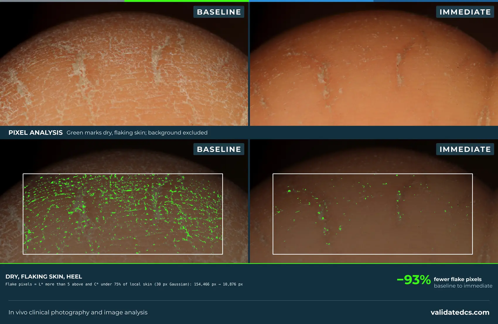 Case study graphic: dry, flaking heel, 93% fewer flake pixels