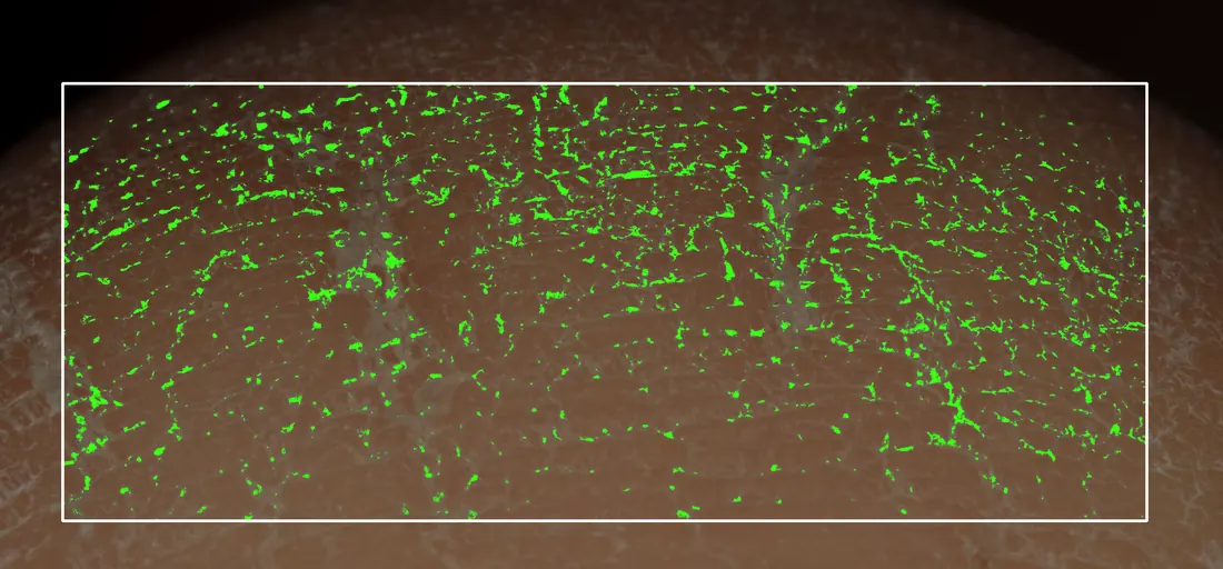Flake pixel analysis of the heel at baseline
