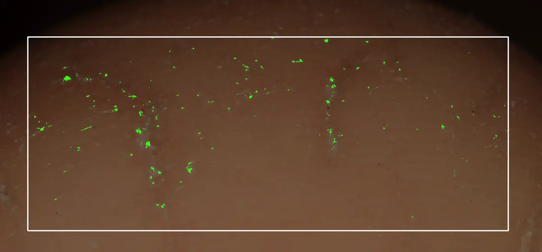 Flake pixel analysis of the heel immediately after treatment