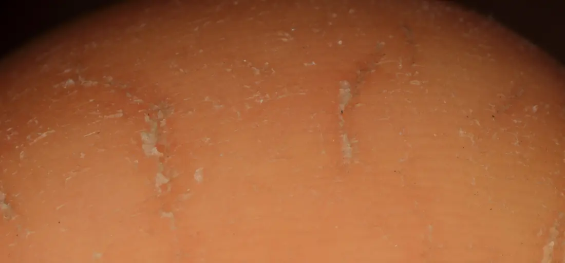 Heel immediately after treatment, with less flaking
