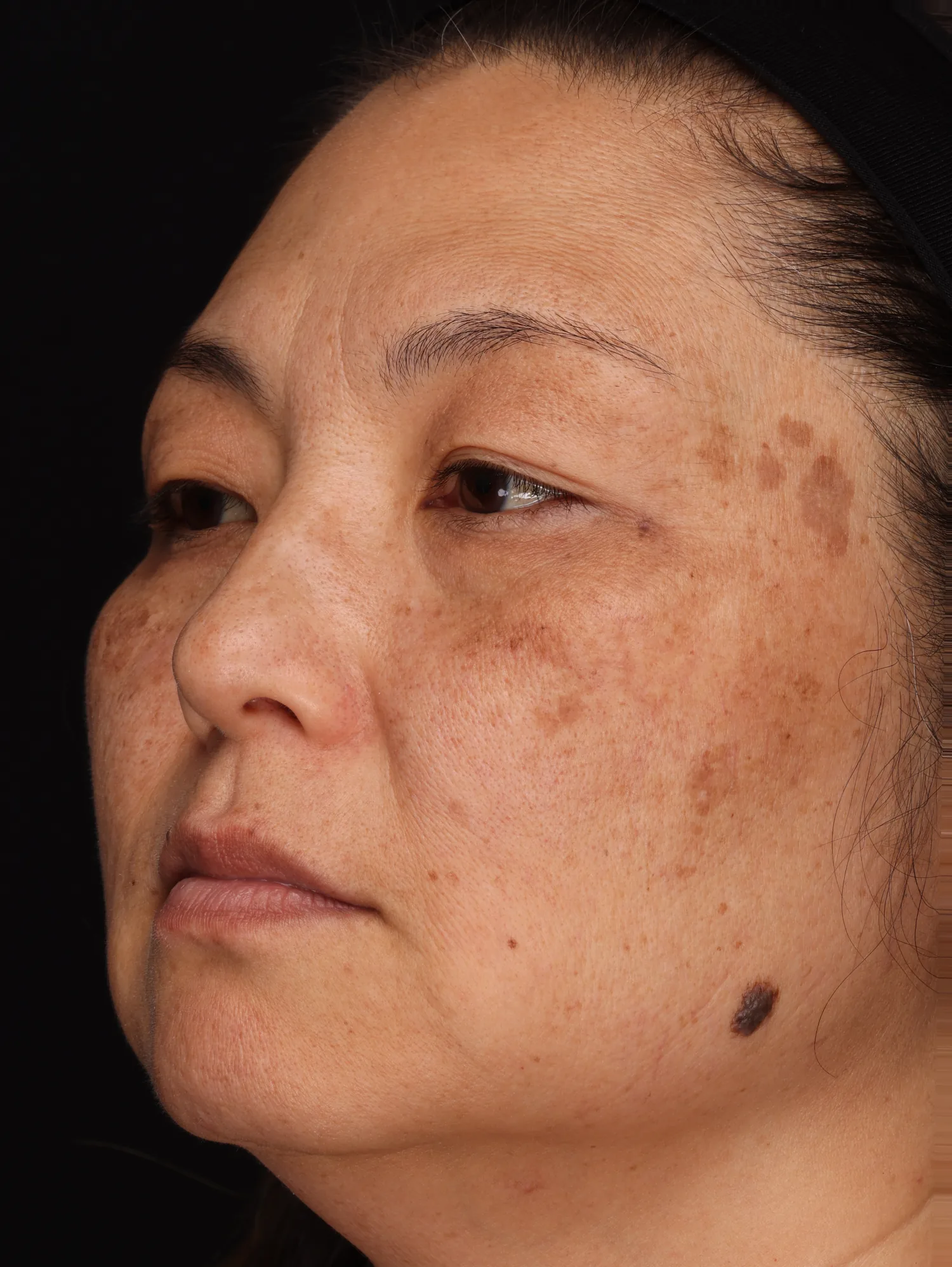 Full face with age spots at week 12