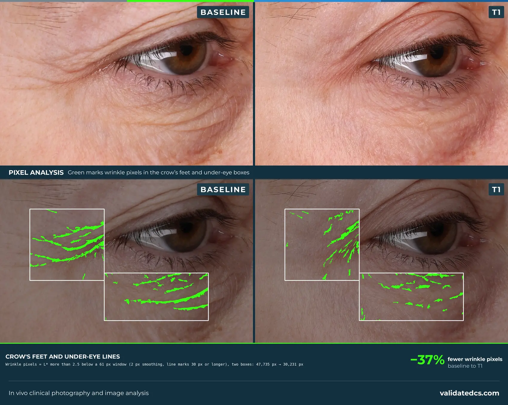 Case study graphic: crow's feet and under-eye, 37% fewer wrinkle pixels from baseline to T1