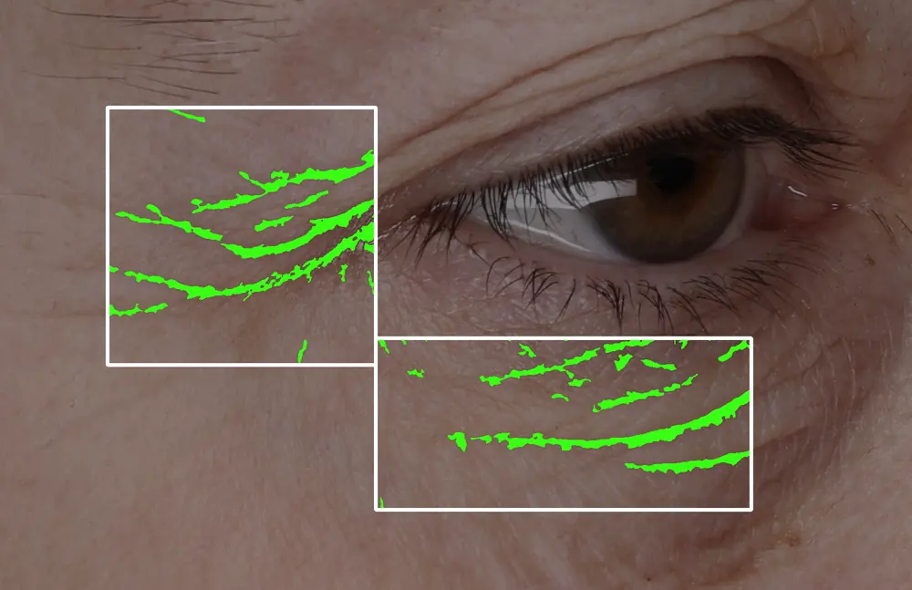 Wrinkle pixel analysis of the eye area at baseline, measured lines shown in green