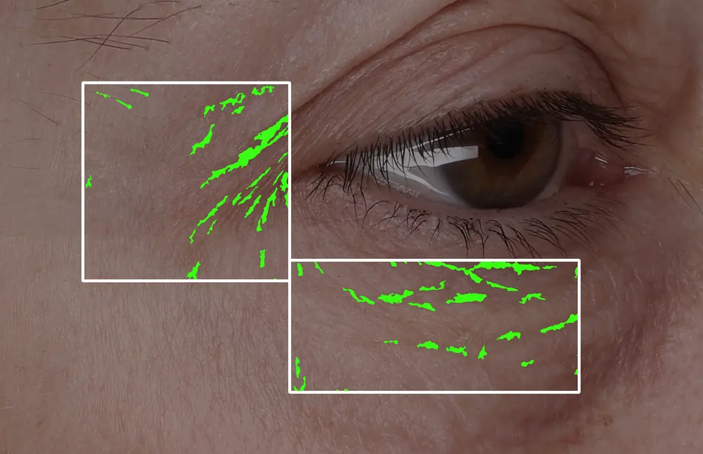 Wrinkle pixel analysis of the eye area at T1, measured lines shown in green