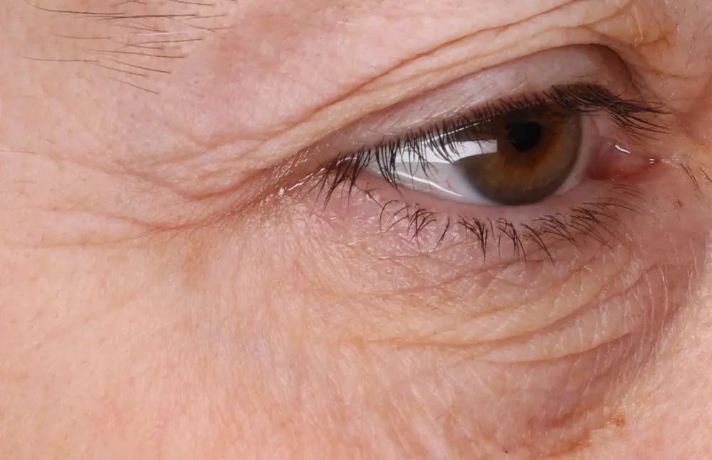 Eye area at baseline, print layout