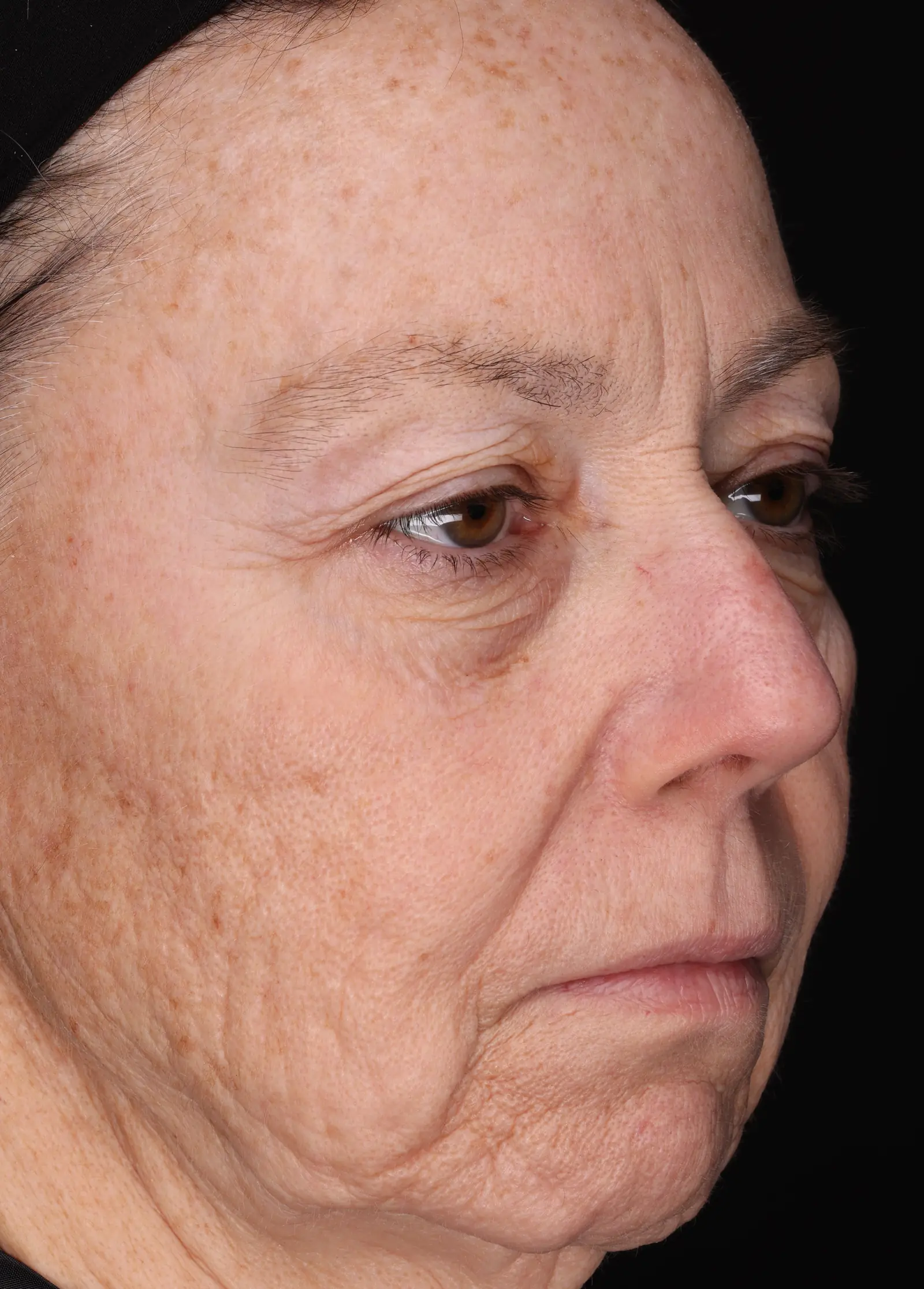 Full face, three-quarter view, at baseline, before treatment for wrinkles