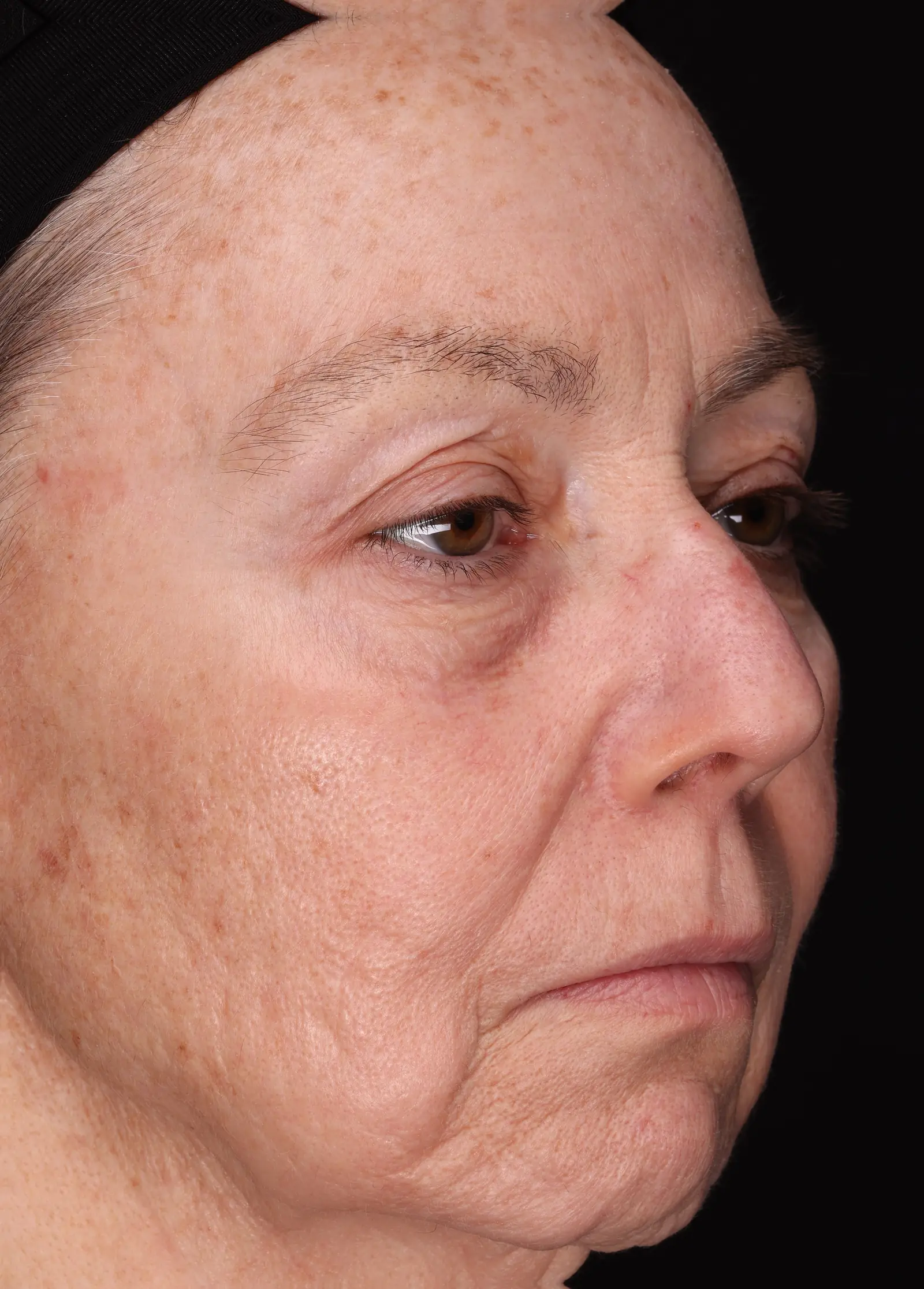 Full face, three-quarter view, at the T1 visit, showing softer crow's feet and under-eye lines