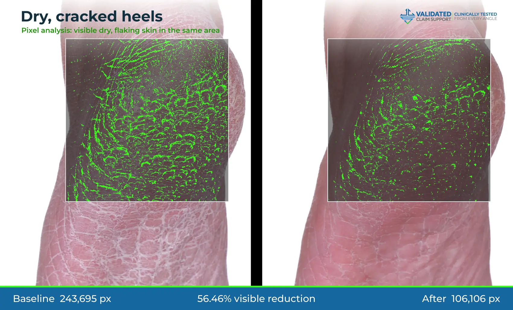 Deck-style graphic: cracked heel, 56.46% visible reduction