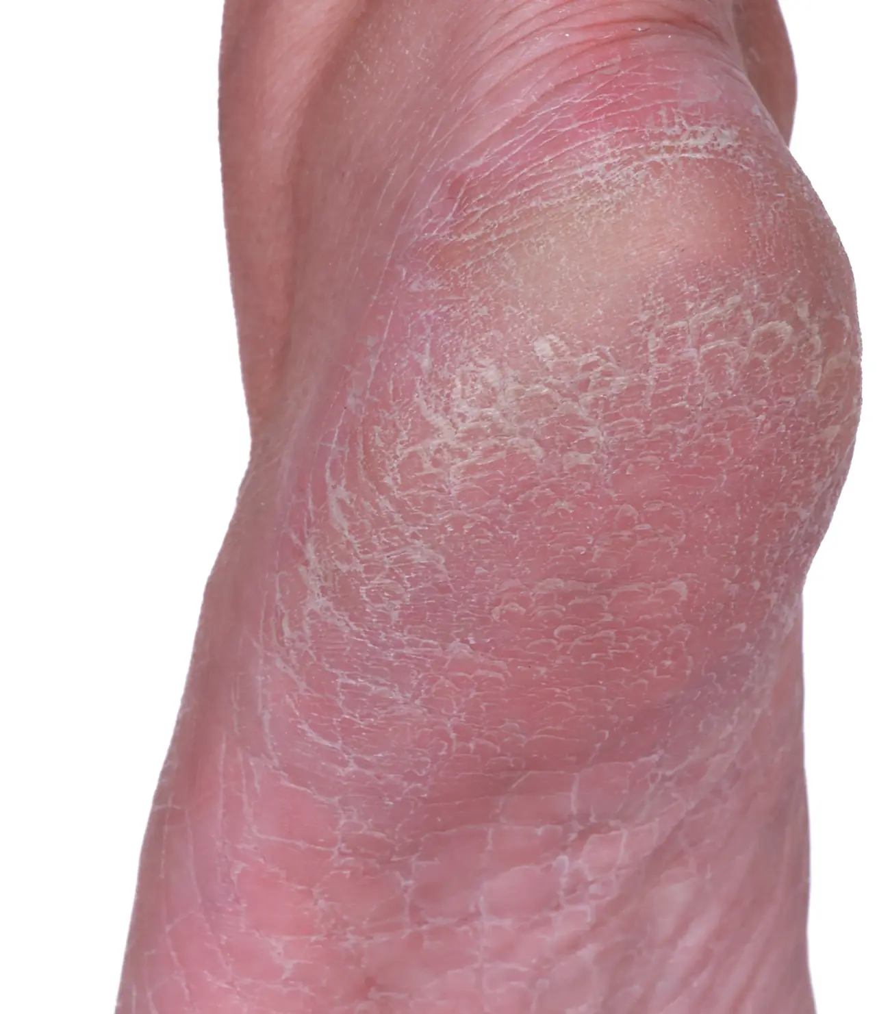 Cracked heel after treatment, with fewer flakes
