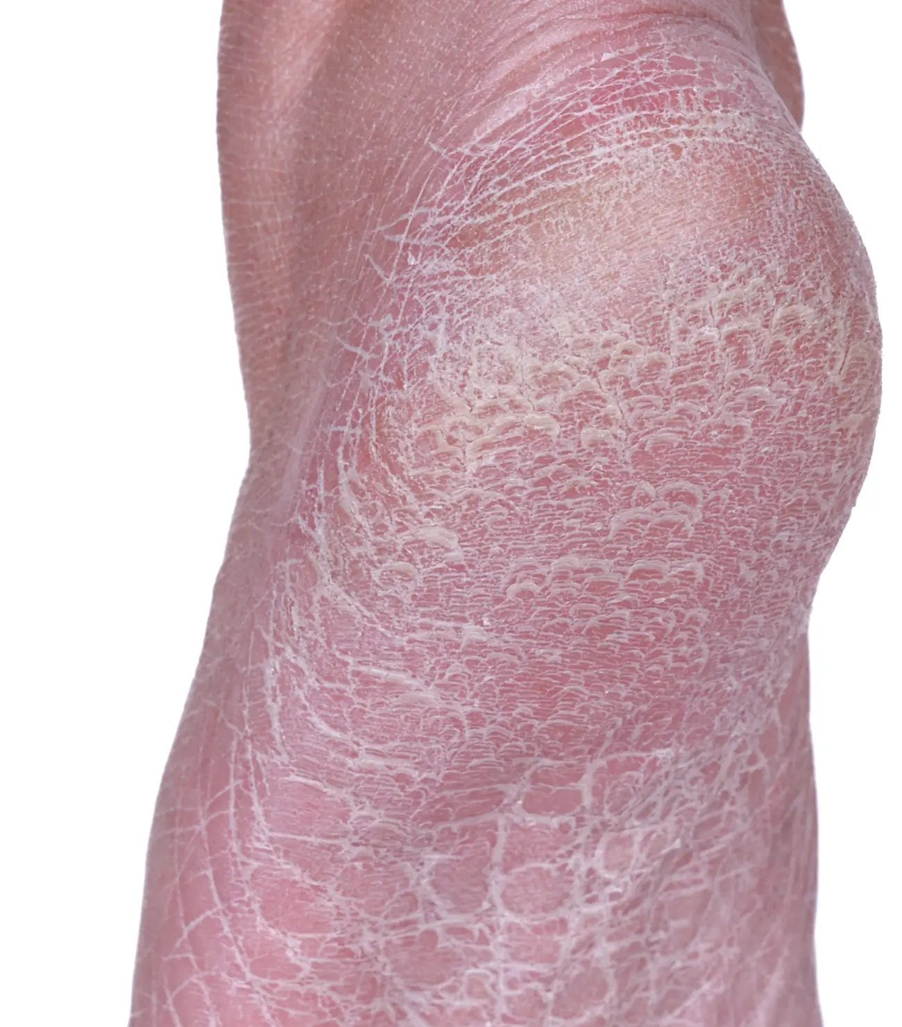 Cracked heel at baseline