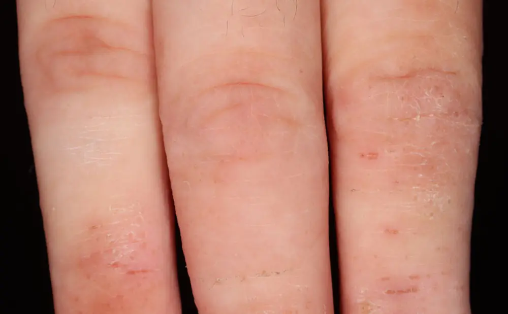 Eczema on the knuckles at week 4